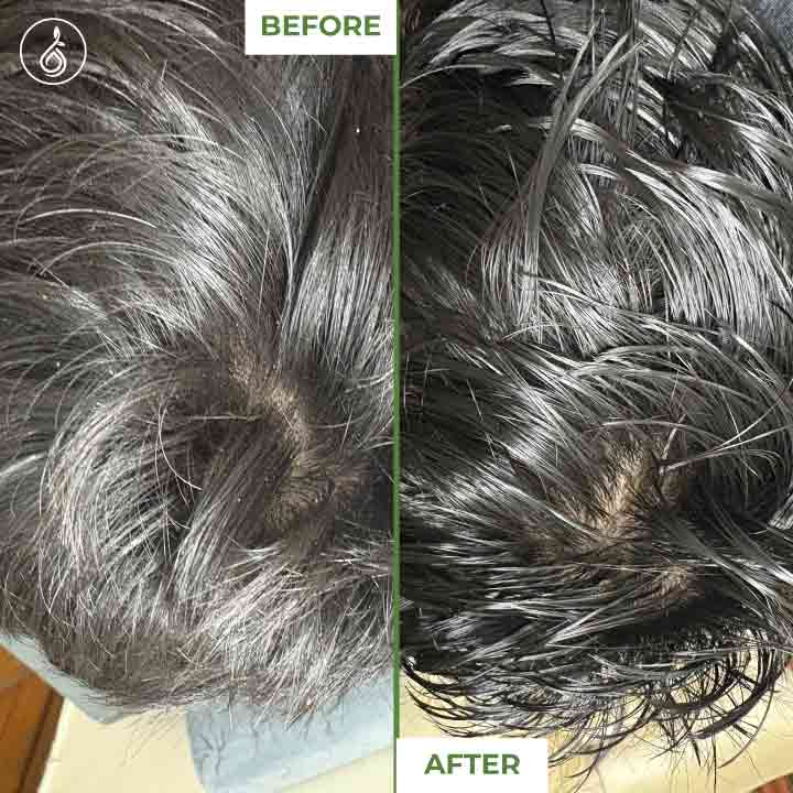 Before and after comparison of hair texture on a scalp after usijng anti dandruff oil