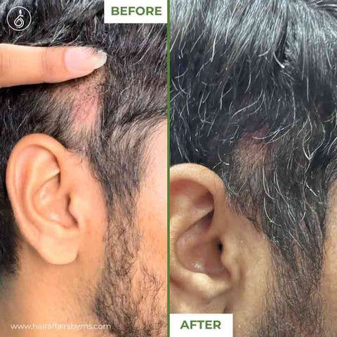 Derma Roller 0.5mm