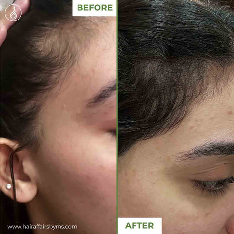 hair loss treatment for women