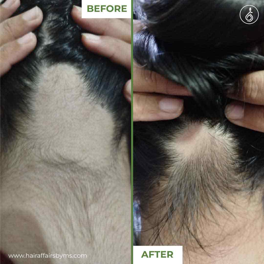 Before & after results of medicated hair loss treatment
