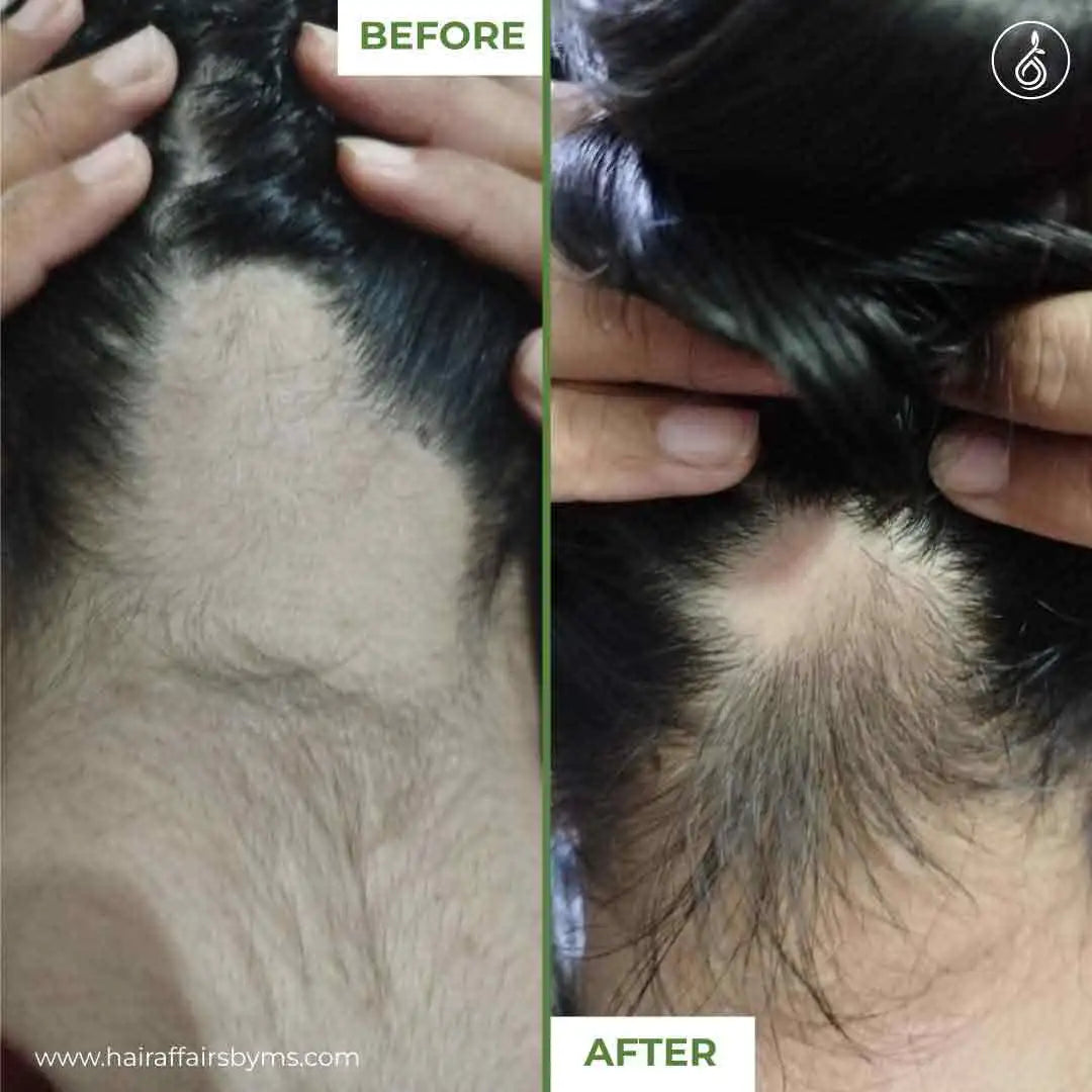 Before & after results of medicated hair loss treatment