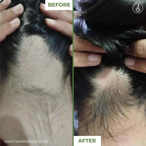 Before & after results of medicated hair loss treatment