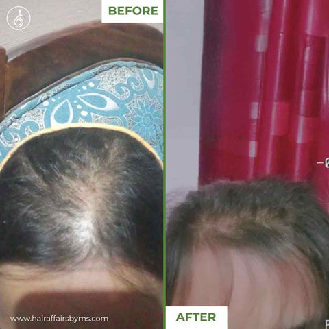 Medicated Hair Loss Treatment 50ml