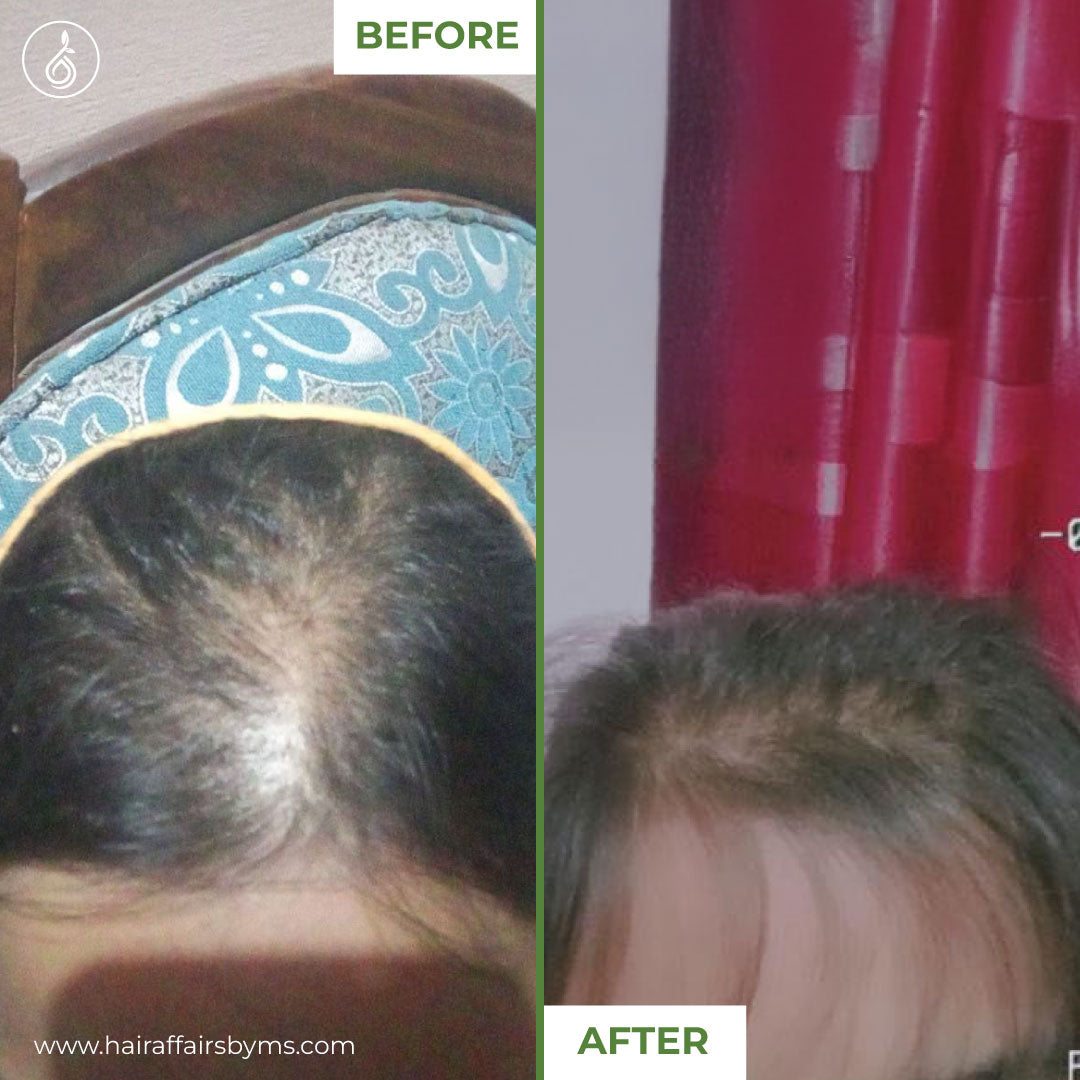 Medicated Hair Loss Treatment