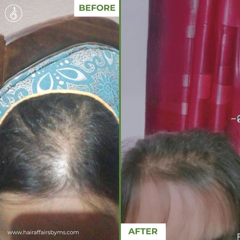 Medicated Hair Loss Treatment